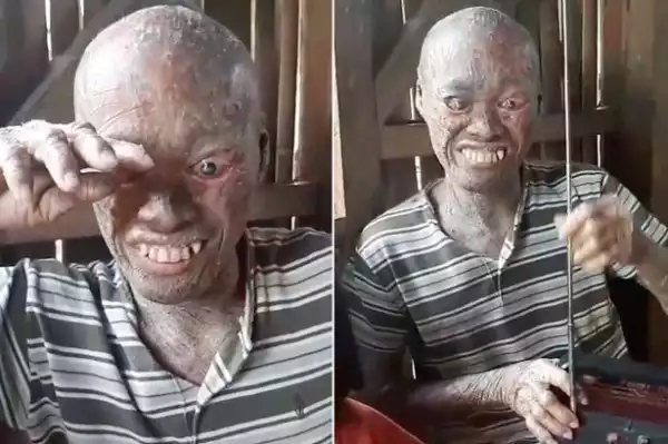 This Man Has Been Bullied His Whole Life Because People Think He Is Cursed. Graphic Photos